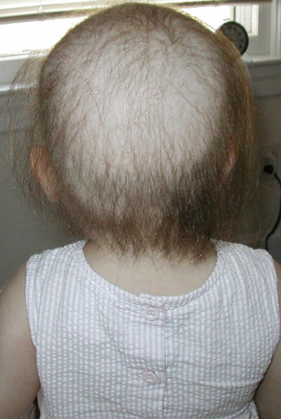 Just one week later, much more hair has fallen out, and it has become quite thin.